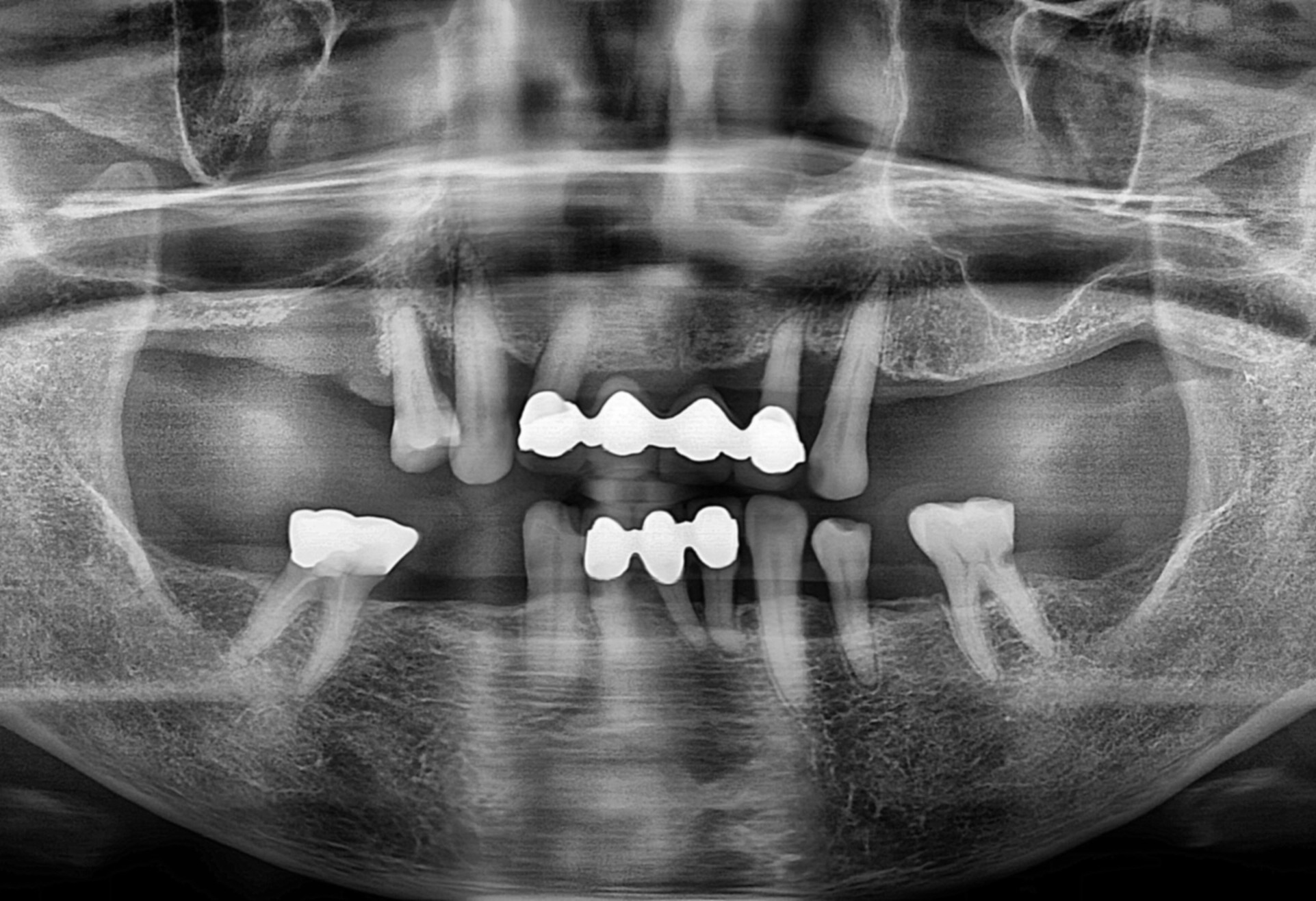 치료 전 X-ray